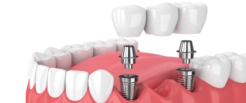 Les implants dentaires